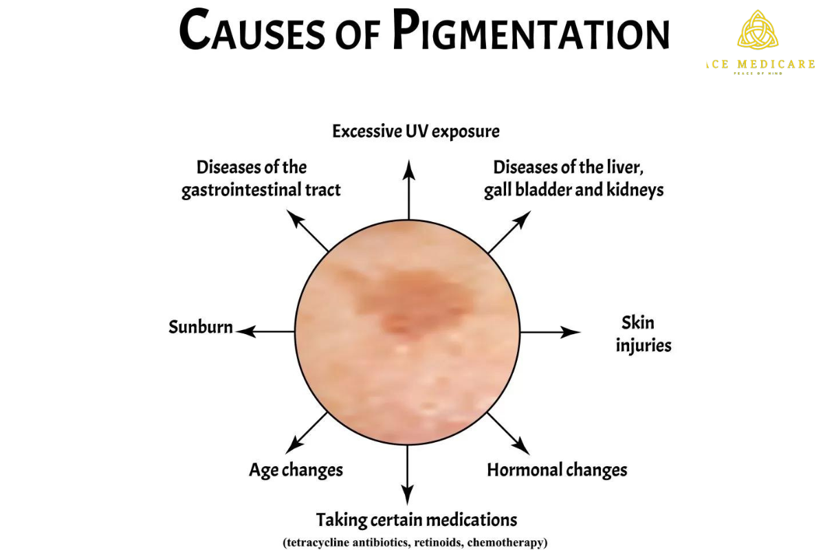 Demystifying Skin Pigmentation: Causes and Treatments